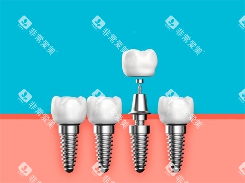 种植牙植体基台和牙冠漫画图 种植牙植体基台和牙冠漫画图