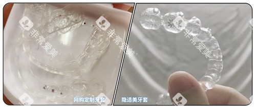 隐形牙套对比照片 隐形牙套对比照片