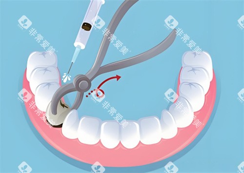 <span class='highlight'>无痛</span>拔牙 <span class='highlight'>无痛</span>拔牙