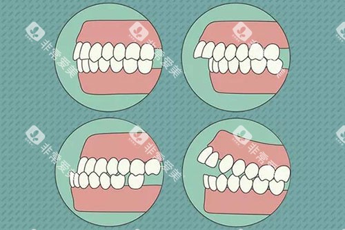 需要牙齿矫正的问题示意图 需要牙齿矫正的问题示意图