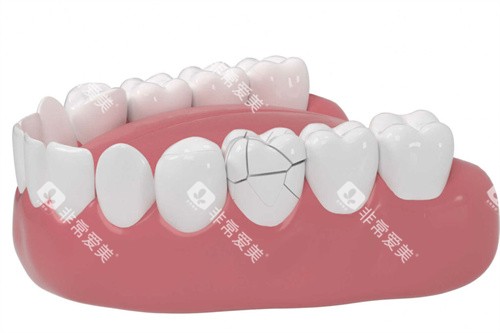 牙齿横向裂纹 牙齿横向裂纹