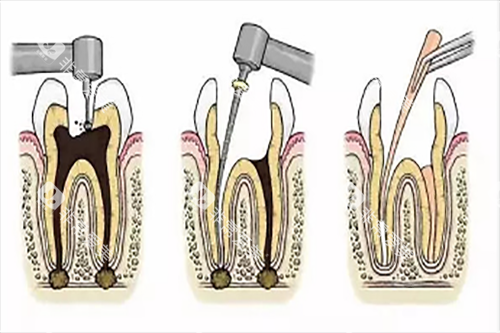 根管治疗步骤1 根管治疗步骤1