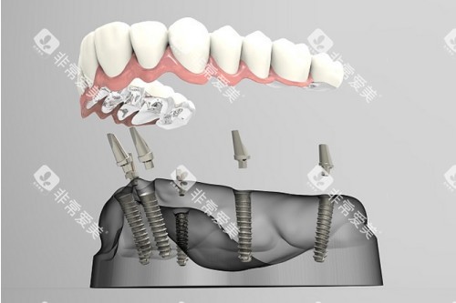 all-on-6种植卡通一览图 all-on-6种植卡通一览图