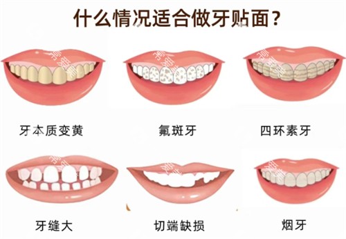 适合做牙贴面的情况