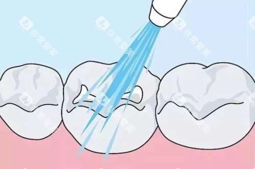 儿牙涂氟卡通图