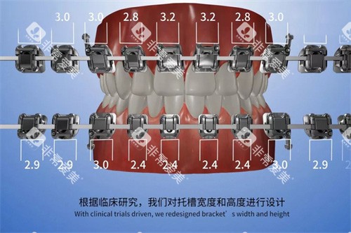 欧晴自锁托槽 (8) 欧晴自锁托槽 (8)