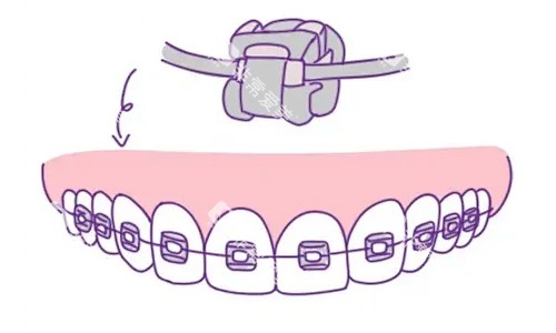 自锁托槽矫正 自锁托槽矫正