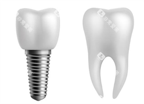 种植牙对比正常牙好在哪 种植牙对比正常牙好在哪