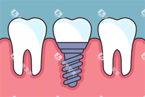 种植牙植入后漫画示意图 种植牙植入后漫画示意图
