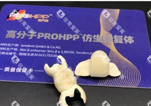 hpp粘接桥牙齿单颗示意图