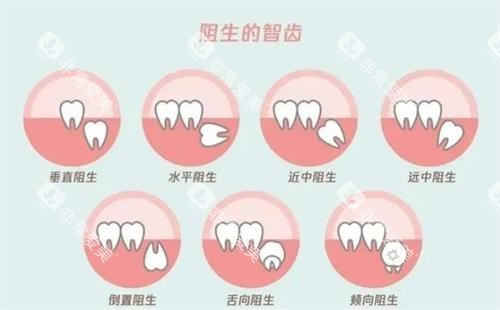 阻生智齿的示意图
