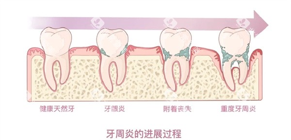 牙周炎