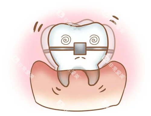 牙齿矫正松动.webp