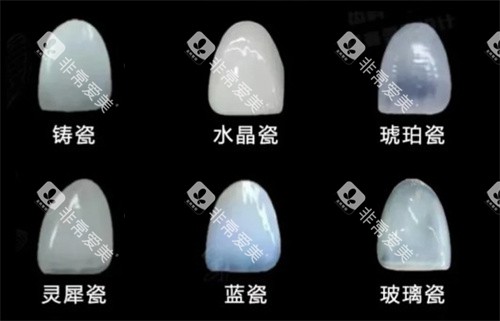 牙贴面材料