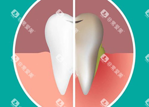 美白牙齿对比