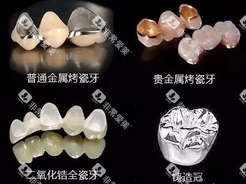 烤瓷牙的不同材质