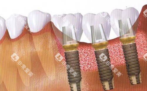 种植牙手术后图 种植牙手术后图