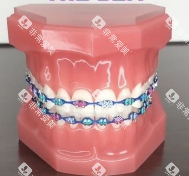 牙齿矫正牙套模型示意图 牙齿矫正牙套模型示意图