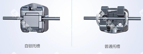 牙齿矫正自锁托槽示意图 牙齿矫正自锁托槽示意图