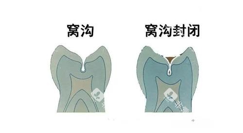 窝沟封闭前后的对比图