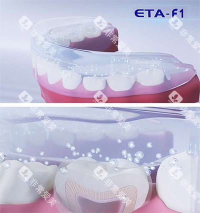 ETA牙齿矫正器