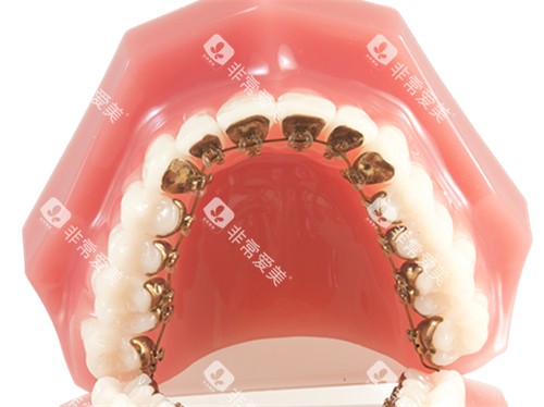 牙齿矫正金属舌侧矫正牙套模型