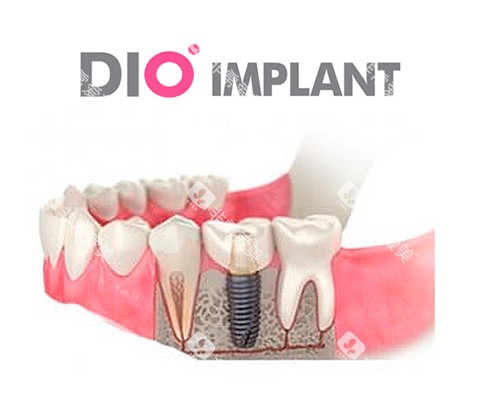 韩国DIO种植牙漫画图 韩国DIO种植牙漫画图