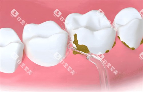 洗牙过程卡通图