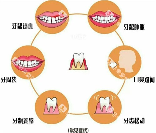 牙周疾病照片