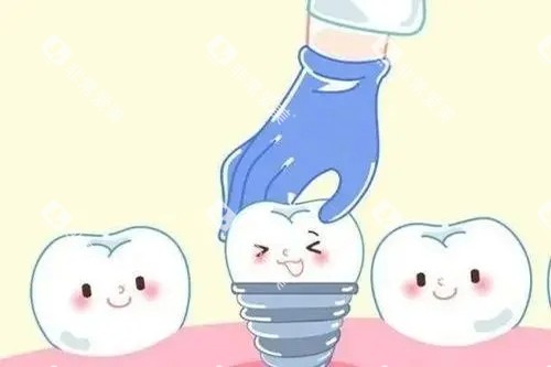 种植牙安装卡通示意图