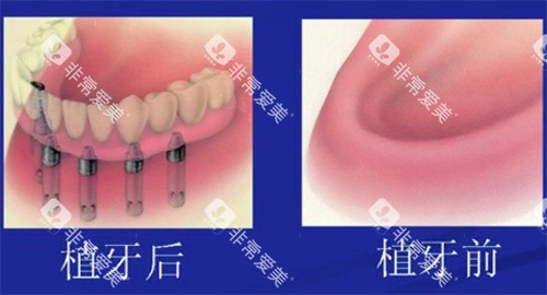 全口种植牙前后