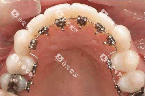 牙齿矫正舌侧矫正 牙齿矫正舌侧矫正