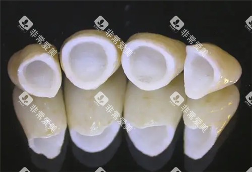 全瓷牙连桥冠照片