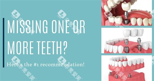 不同种植牙方式图示