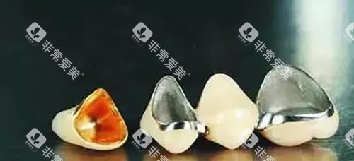 烤瓷牙冠实物示意图