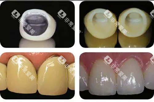烤瓷牙冠和全瓷牙冠安装前后对比