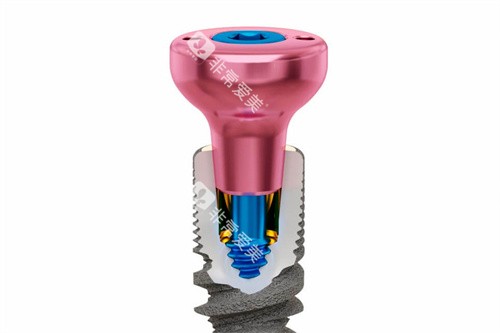 种植牙愈合基台透视图