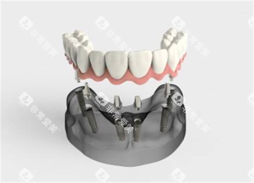 半口种植牙卡通图示意图
