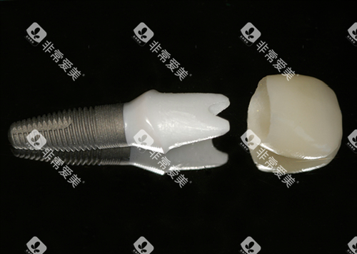 种植牙组成部位图