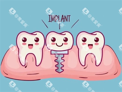种植牙漫画示意图