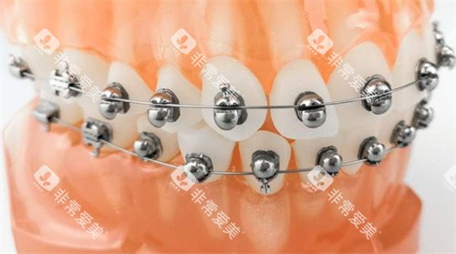 球面自锁托槽矫正 球面自锁托槽矫正