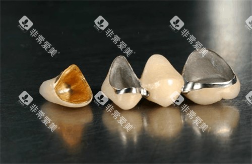 不同材质的烤瓷牙