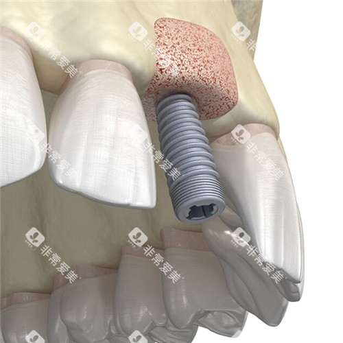 种植牙植骨 种植牙植骨