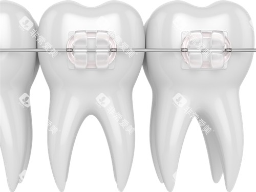 牙齿矫正透明托槽示意图 牙齿矫正透明托槽示意图
