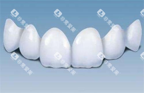 全瓷牙的示意图