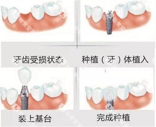 种植牙的手术过程