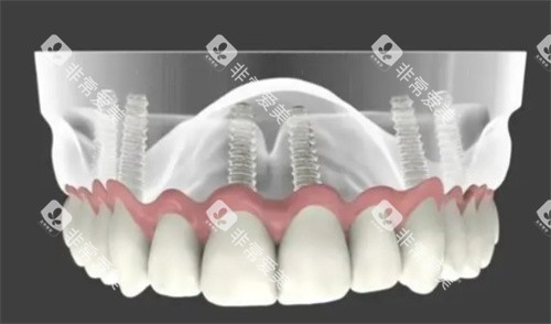 全口种植牙解析图