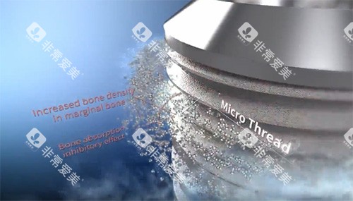 沃兰种植牙表面材料图