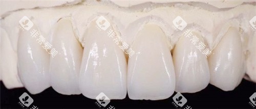 vita全瓷牙展示
