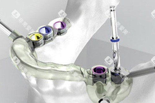 成都新桥口腔疑难种植示意图